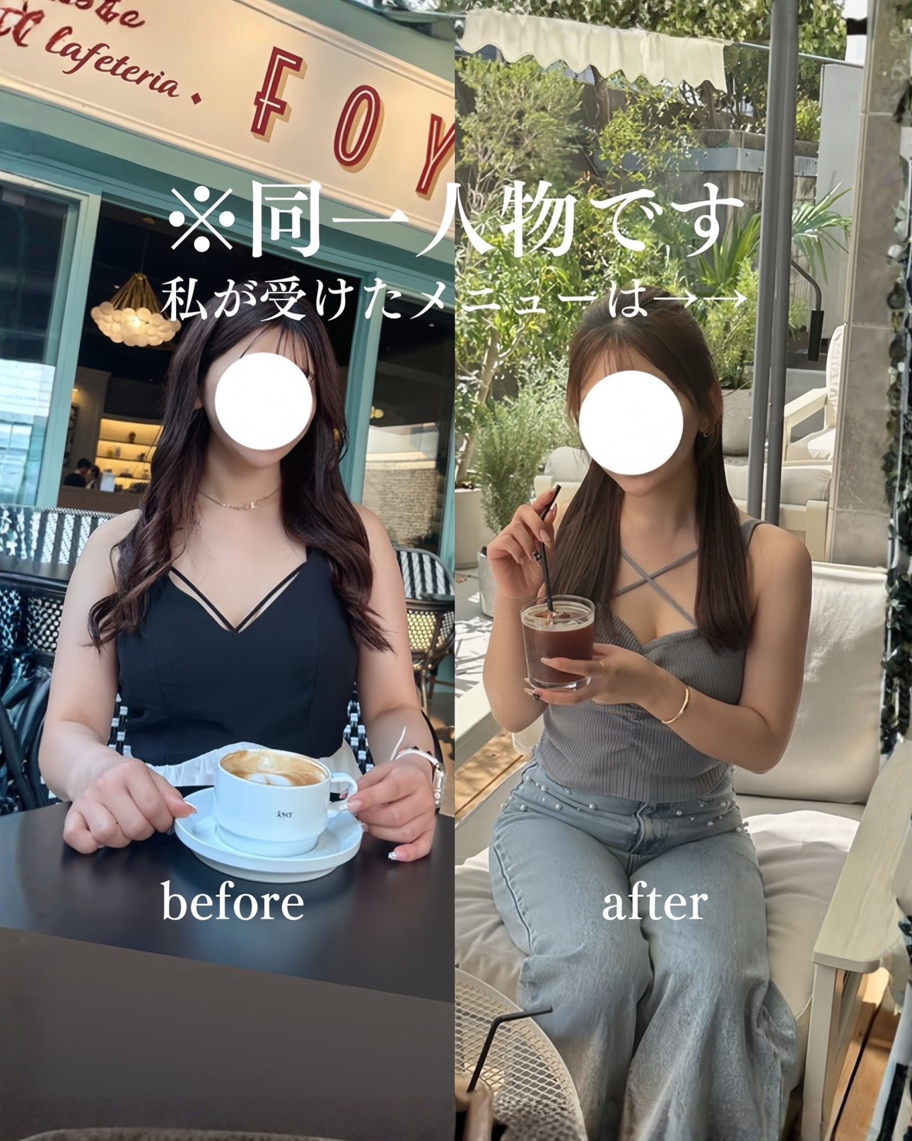 二の腕脂肪吸引ー症例写真