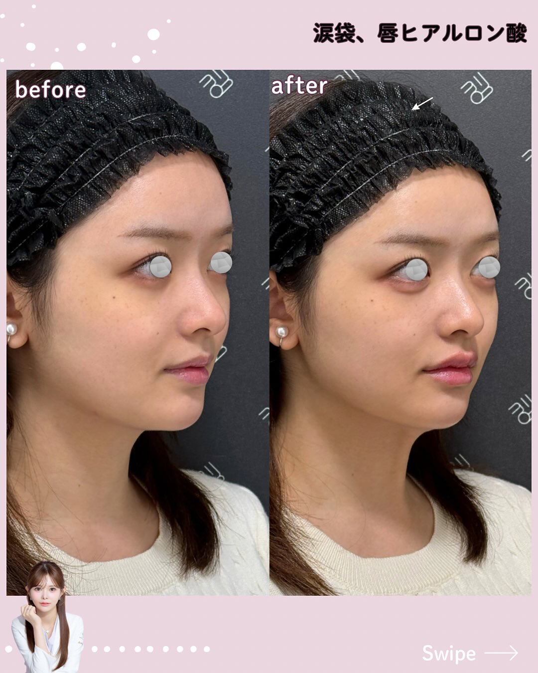 中顔面短縮ヒアルロン酸