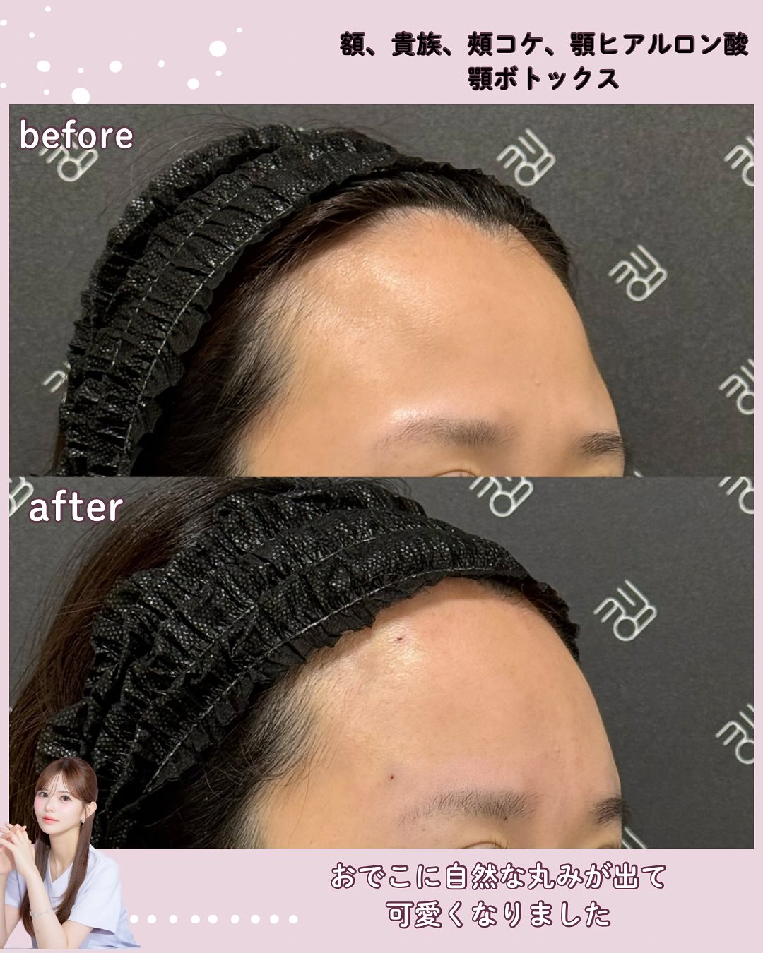 カスタマイズヒアル