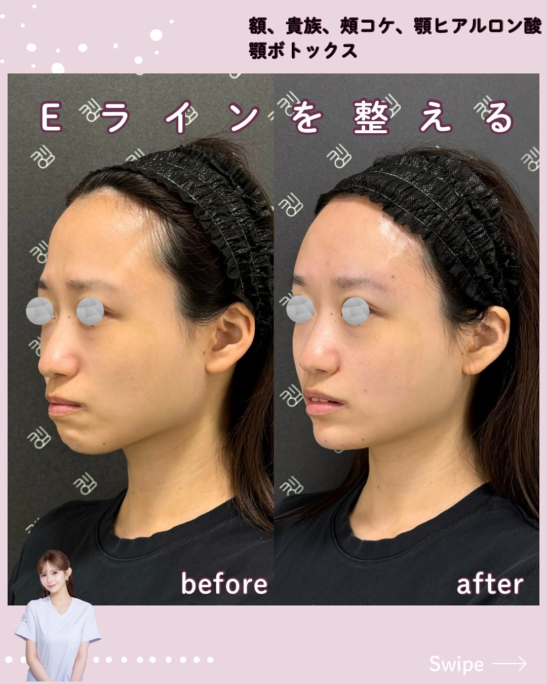 カスタマイズヒアル