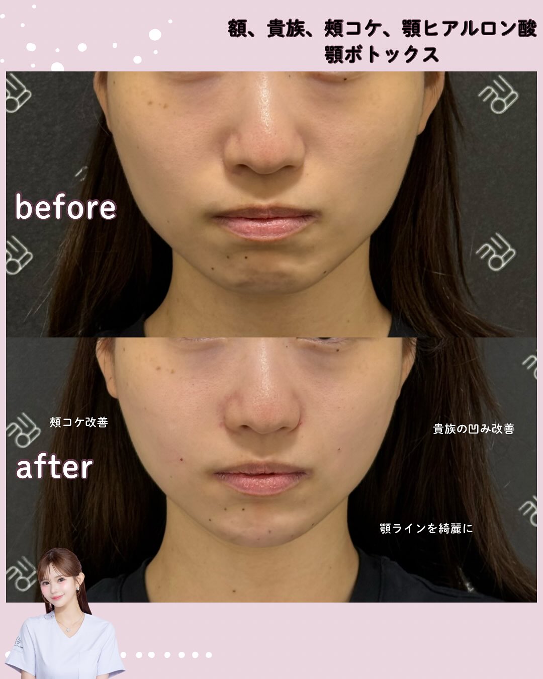 カスタマイズヒアル