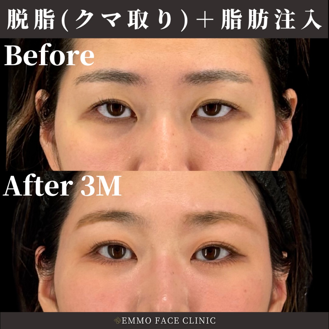 クマ取り(脱脂)