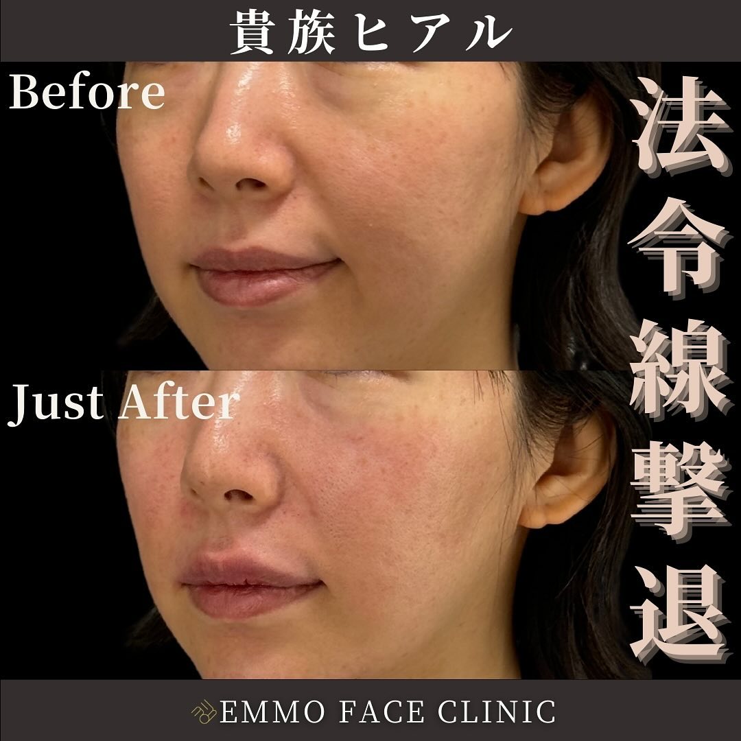 貴族ヒアルロン酸