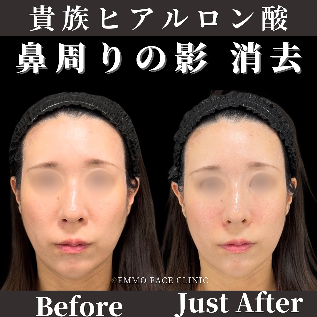 貴族ヒアルロン酸