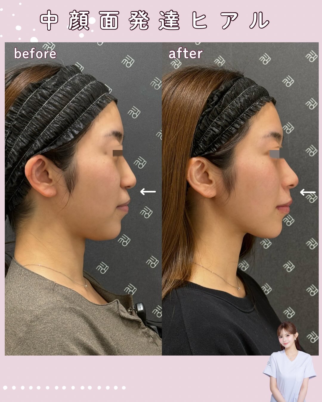 ヒアルロン酸(猫貴族・鼻中隔・唇)|No.0376 | EMMO FACE CLINIC|大宮 東京三田 大阪梅田 の美容外科・美容皮膚科
