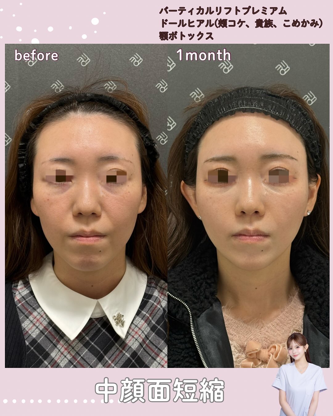 バーティカルリフト