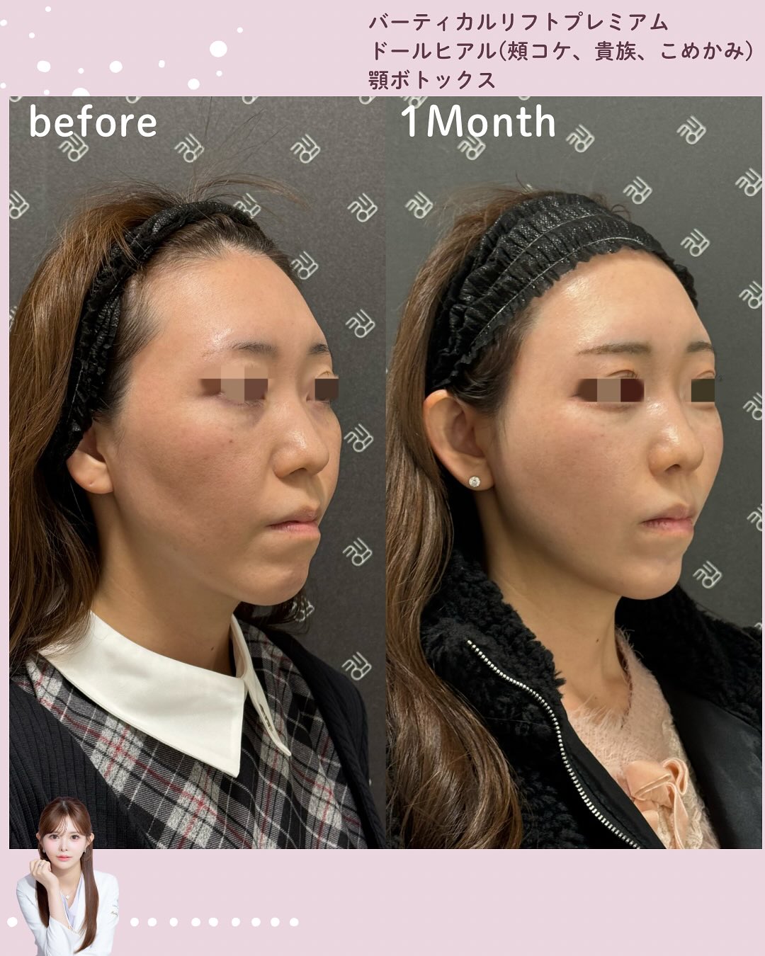 バーティカルリフト