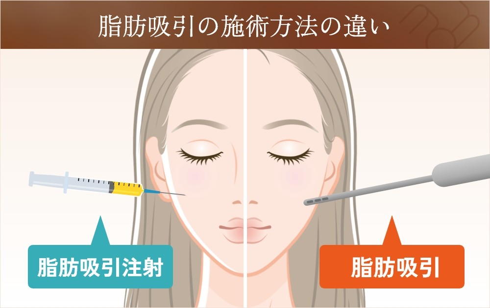 脂肪吸引の施術法の違い