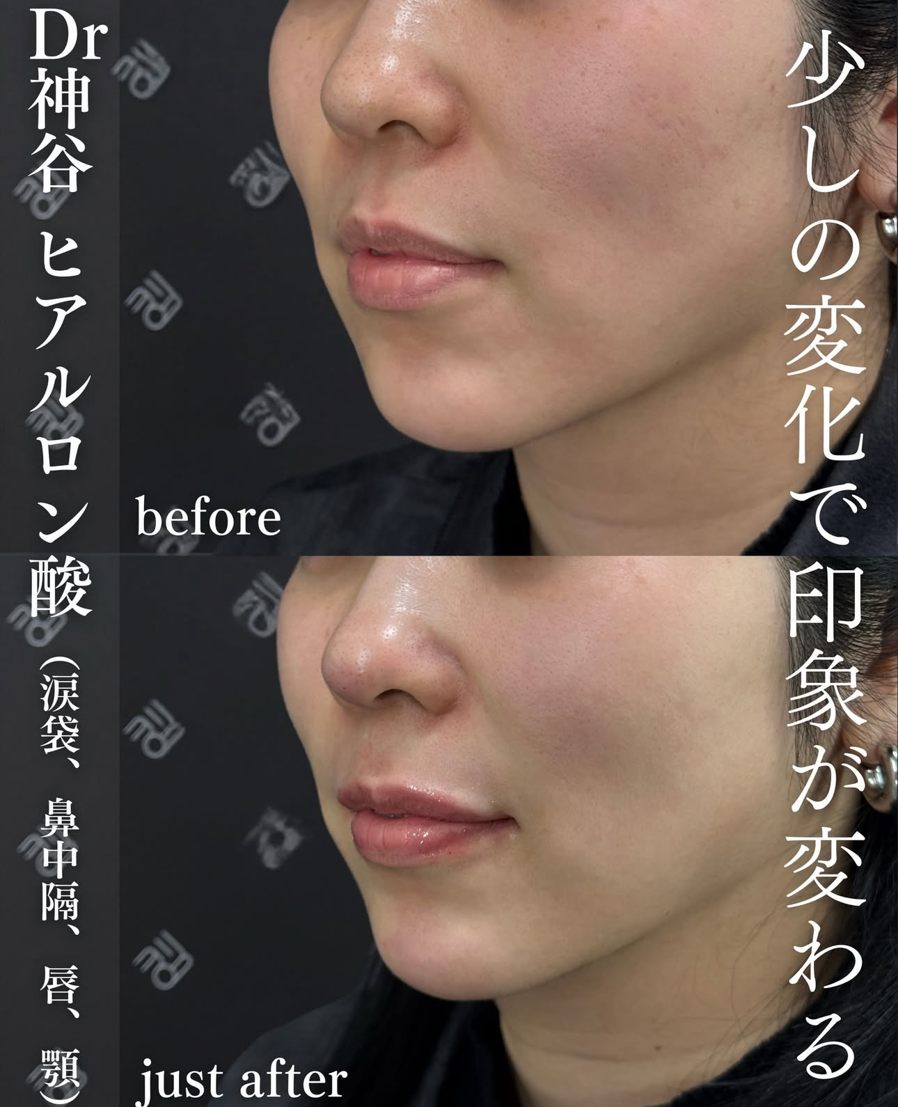 唇ヒアルロン酸ー症例写真