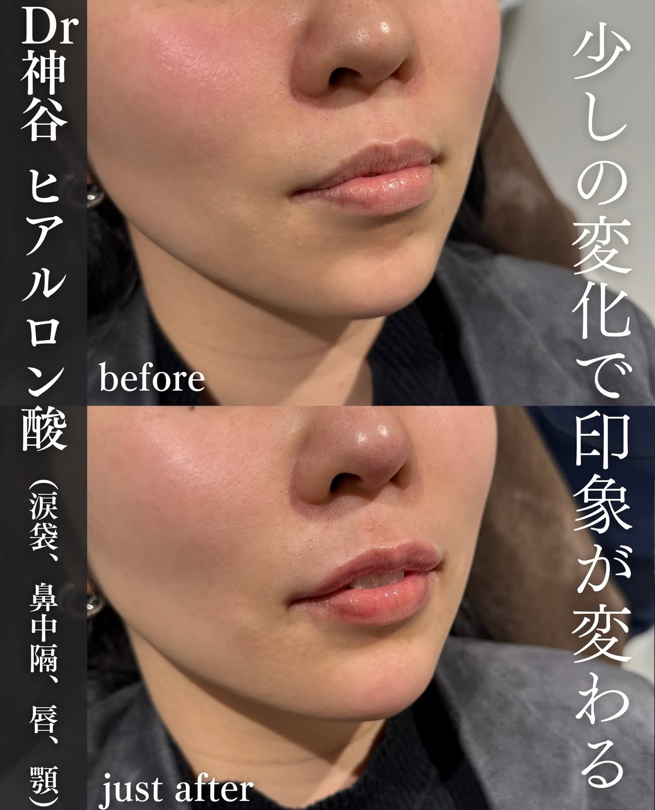 唇ヒアルロン酸ー症例写真