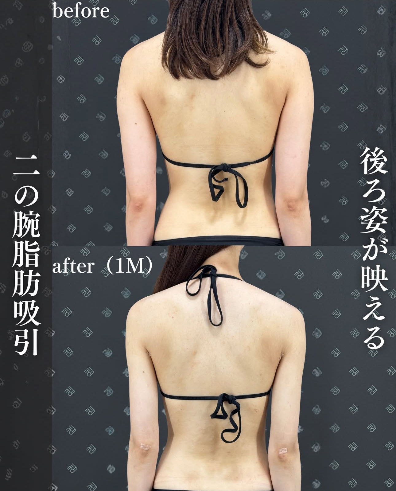 二の腕脂肪吸引