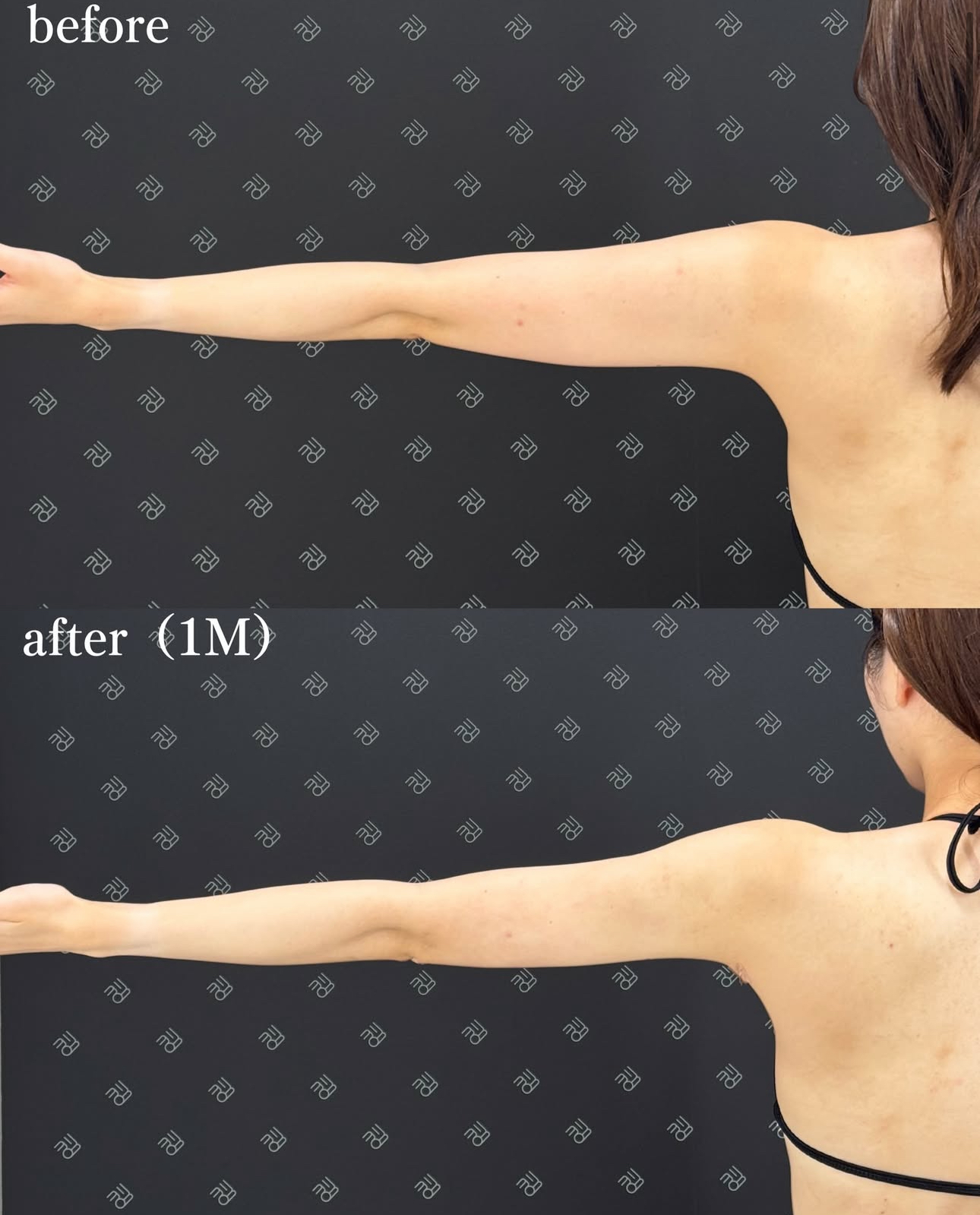 二の腕脂肪吸引