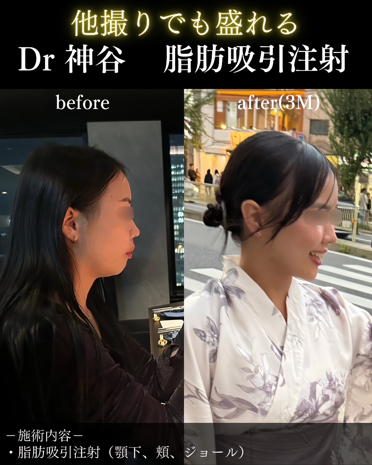 症例写真ー脂肪吸引注射