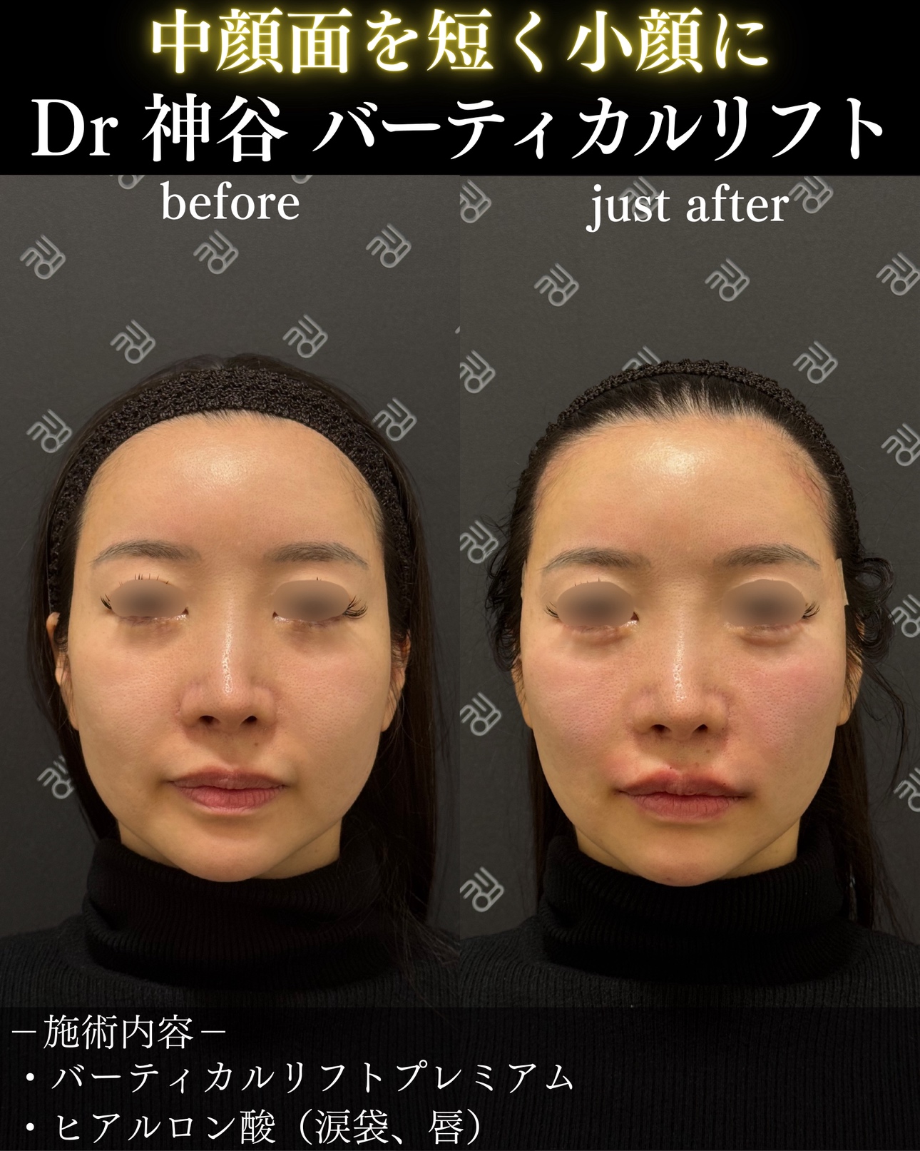 症例写真ーバーティカルリフト