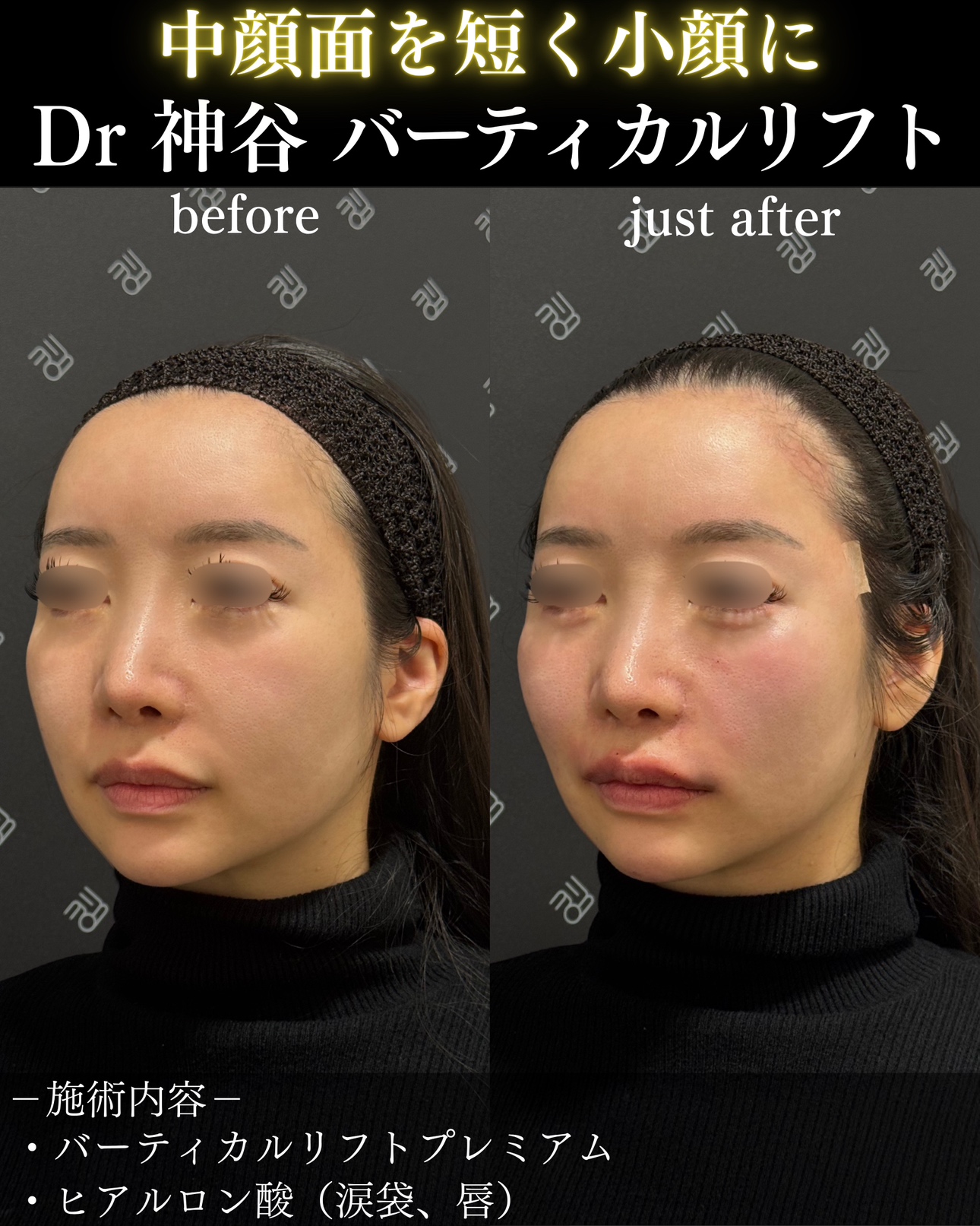 症例写真ーバーティカルリフト