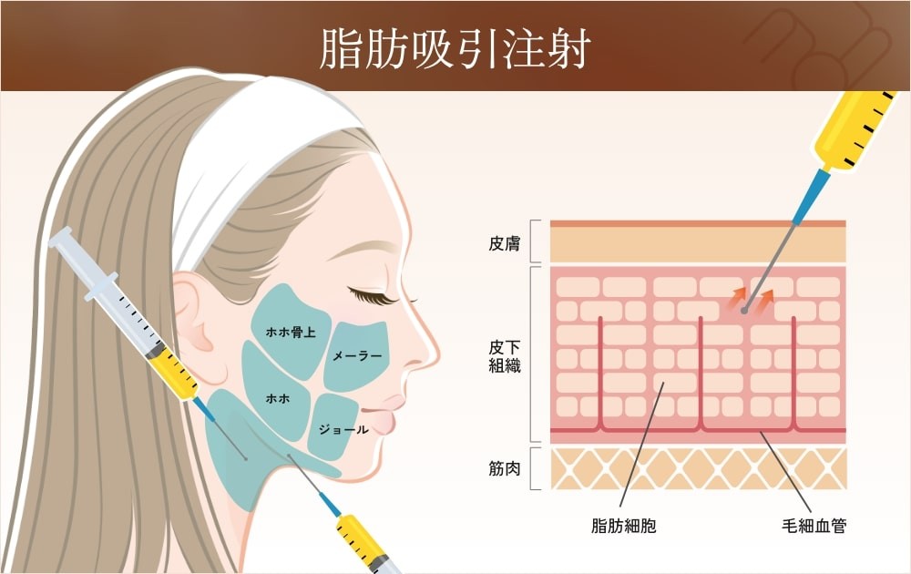 小顔の脂肪吸引注射