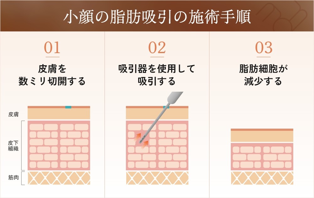 小顔の脂肪吸引