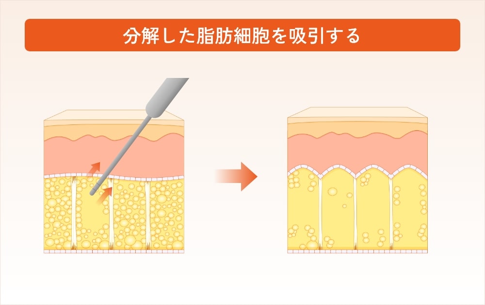 脂肪細胞を吸引