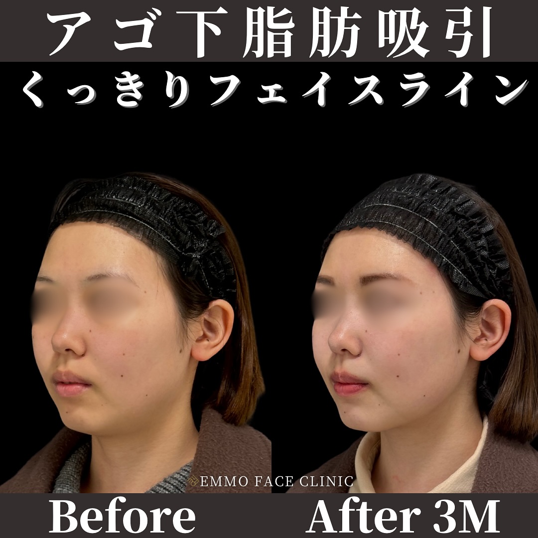 アゴ下脂肪吸引