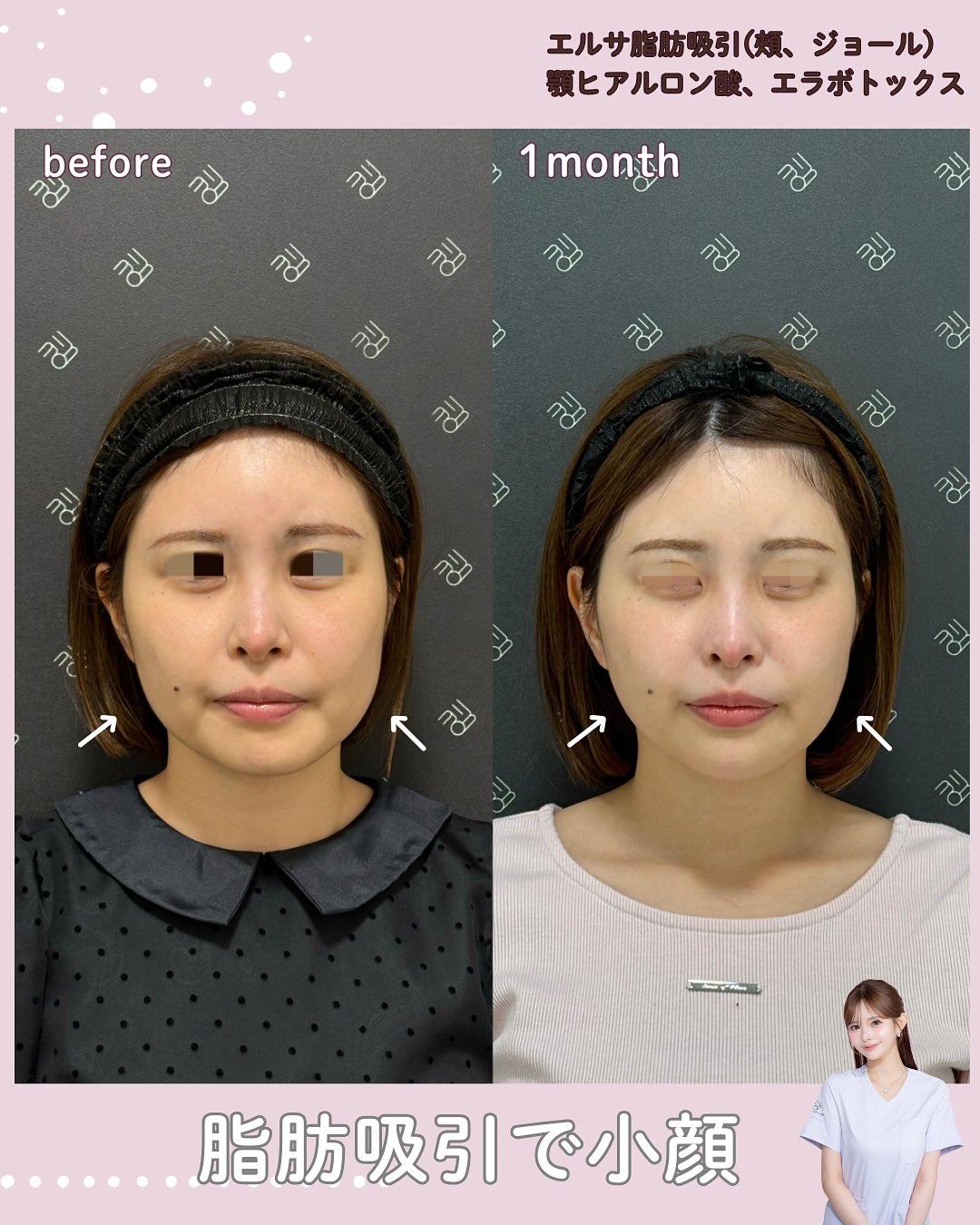 脂肪吸引×ヒアルロン酸×ボトックス