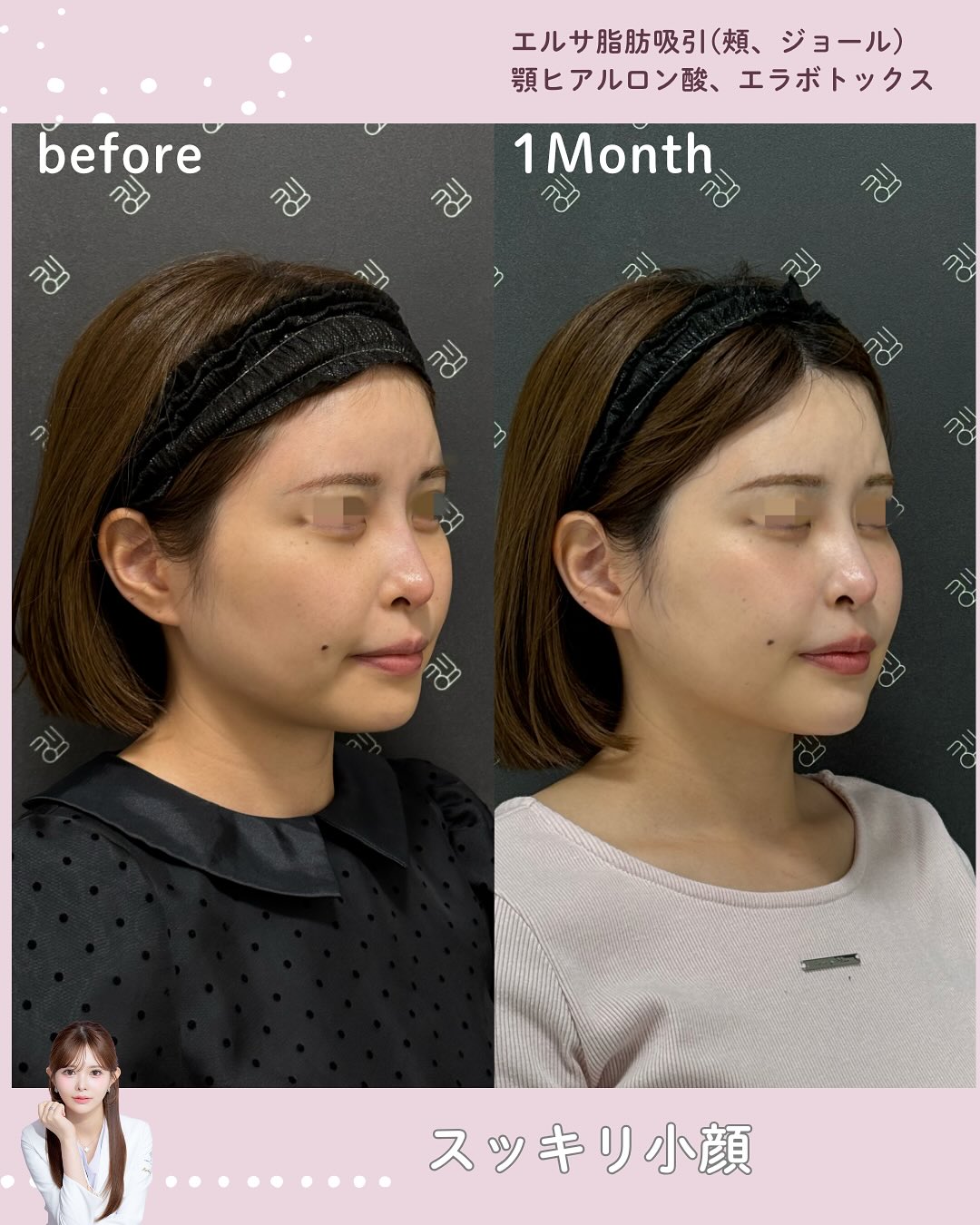 脂肪吸引×ヒアルロン酸×ボトックス