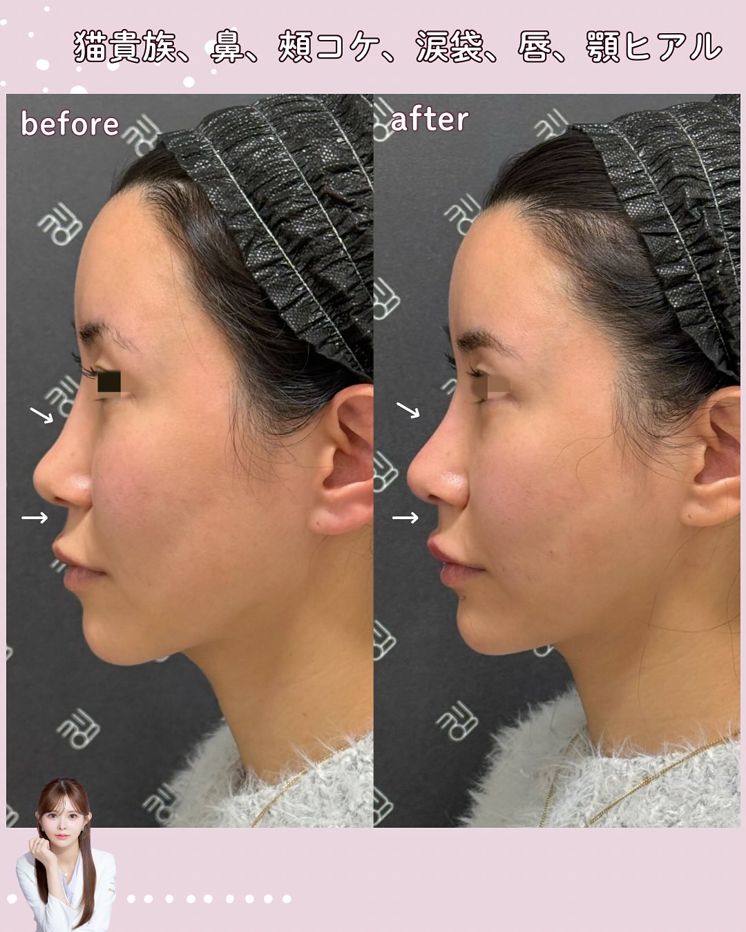 カスタマイズヒアル