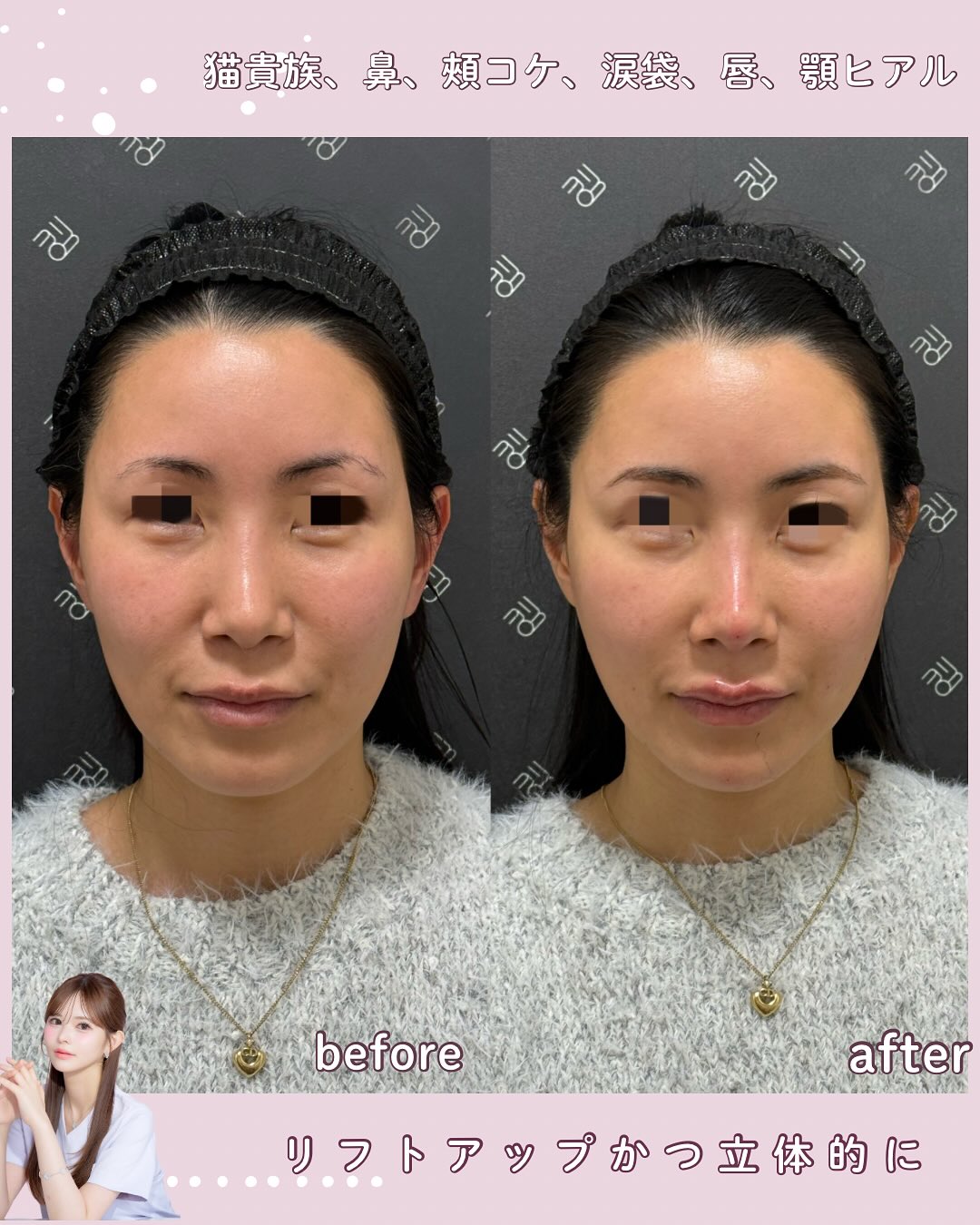 カスタマイズヒアル