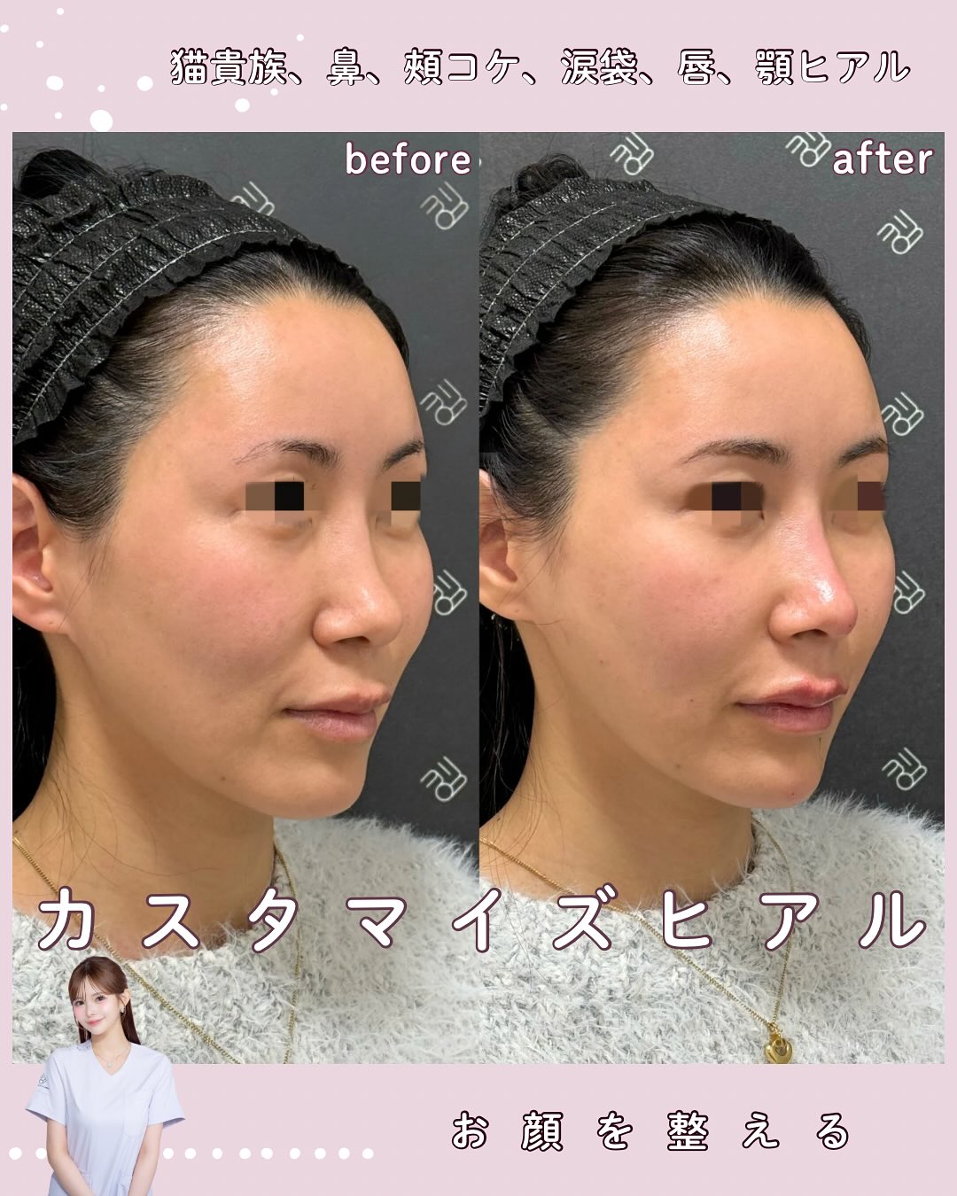 カスタマイズヒアル