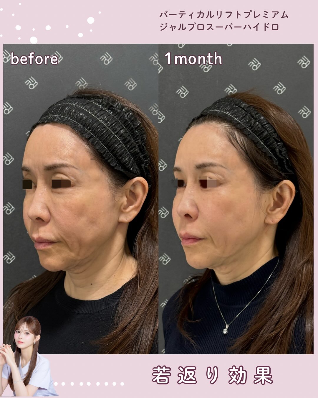 バーティカルリフトプレミアム×ジャルプロスーパーハイドロ