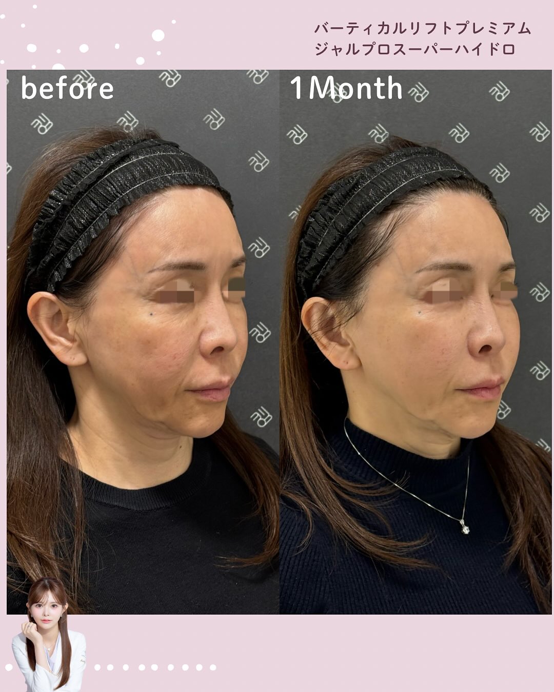 バーティカルリフトプレミアム×ジャルプロスーパーハイドロ