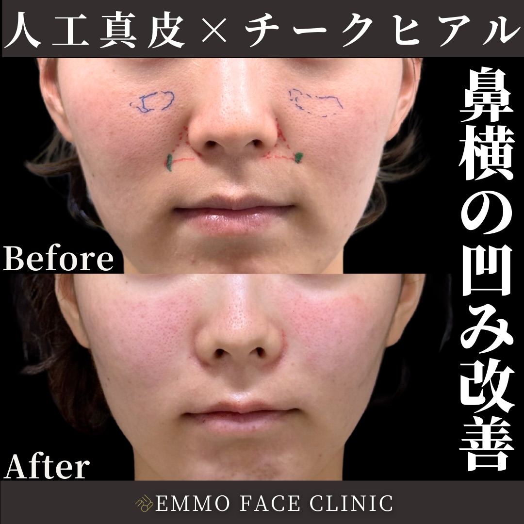 人工真皮×チークヒアルロン酸