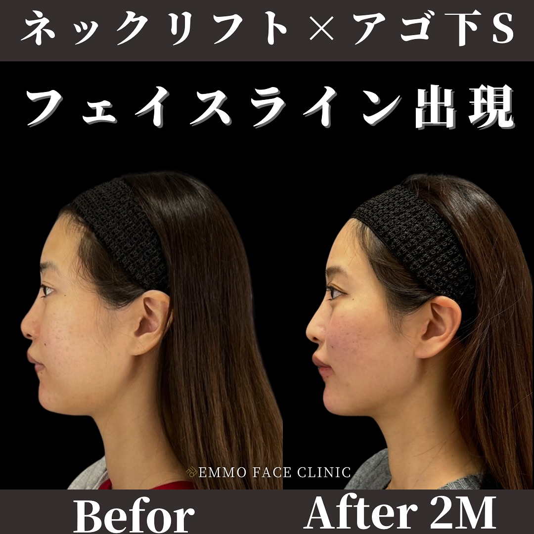 顎下脂肪吸引×糸リフト