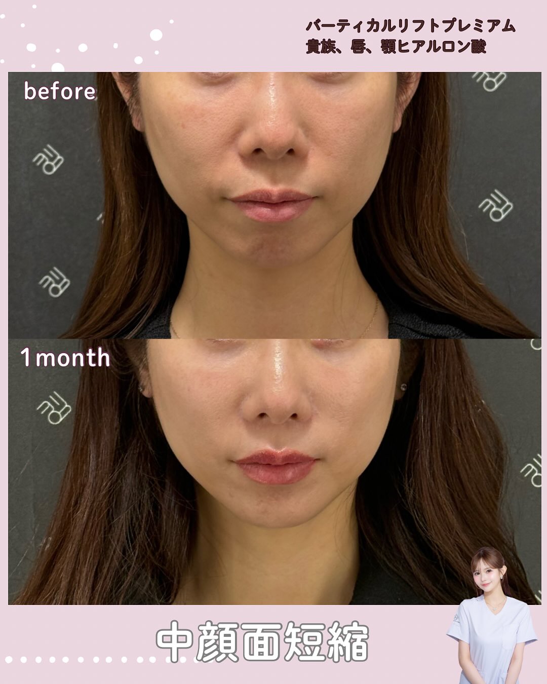 バーティカルリフトプレミアム