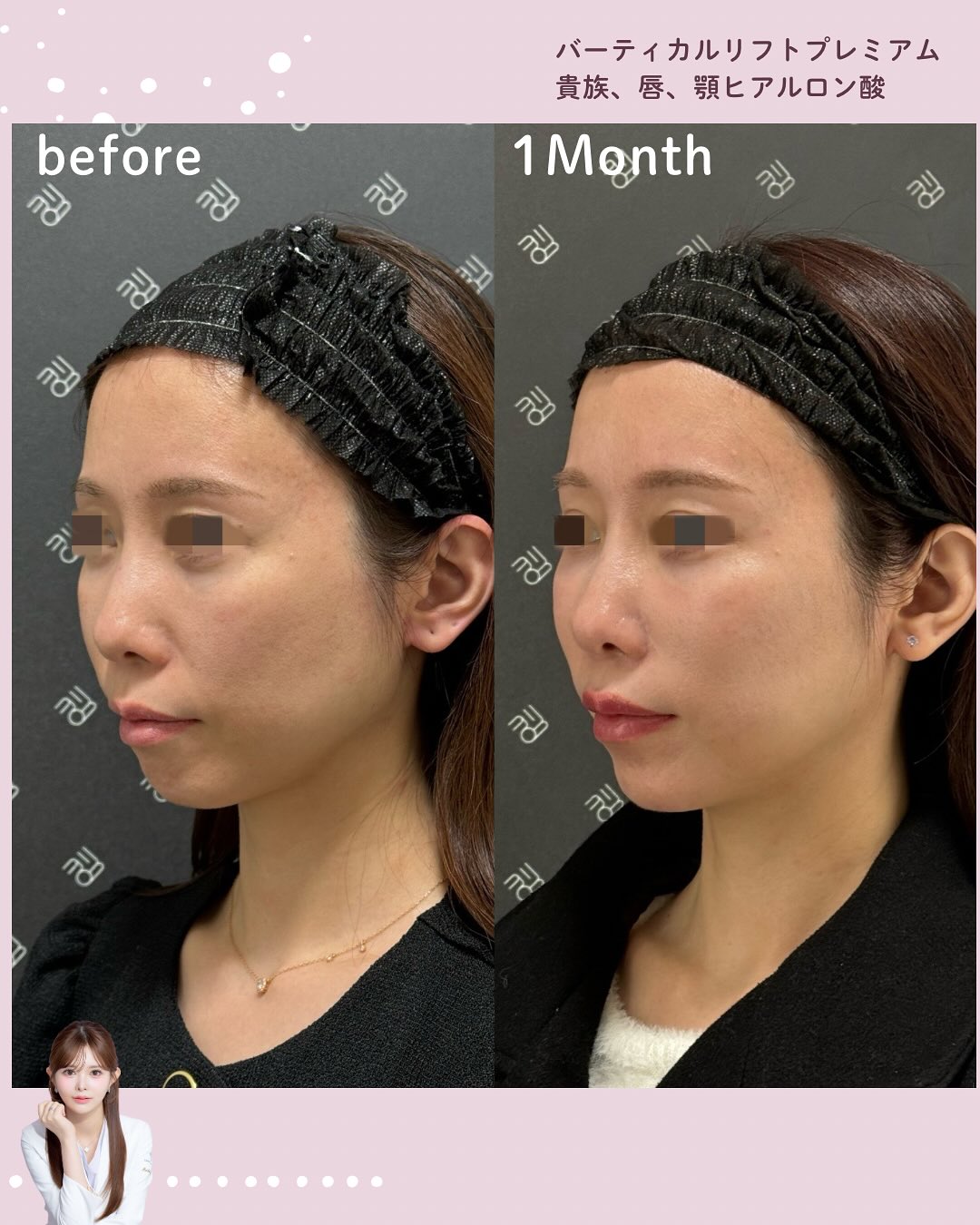 バーティカルリフトプレミアム