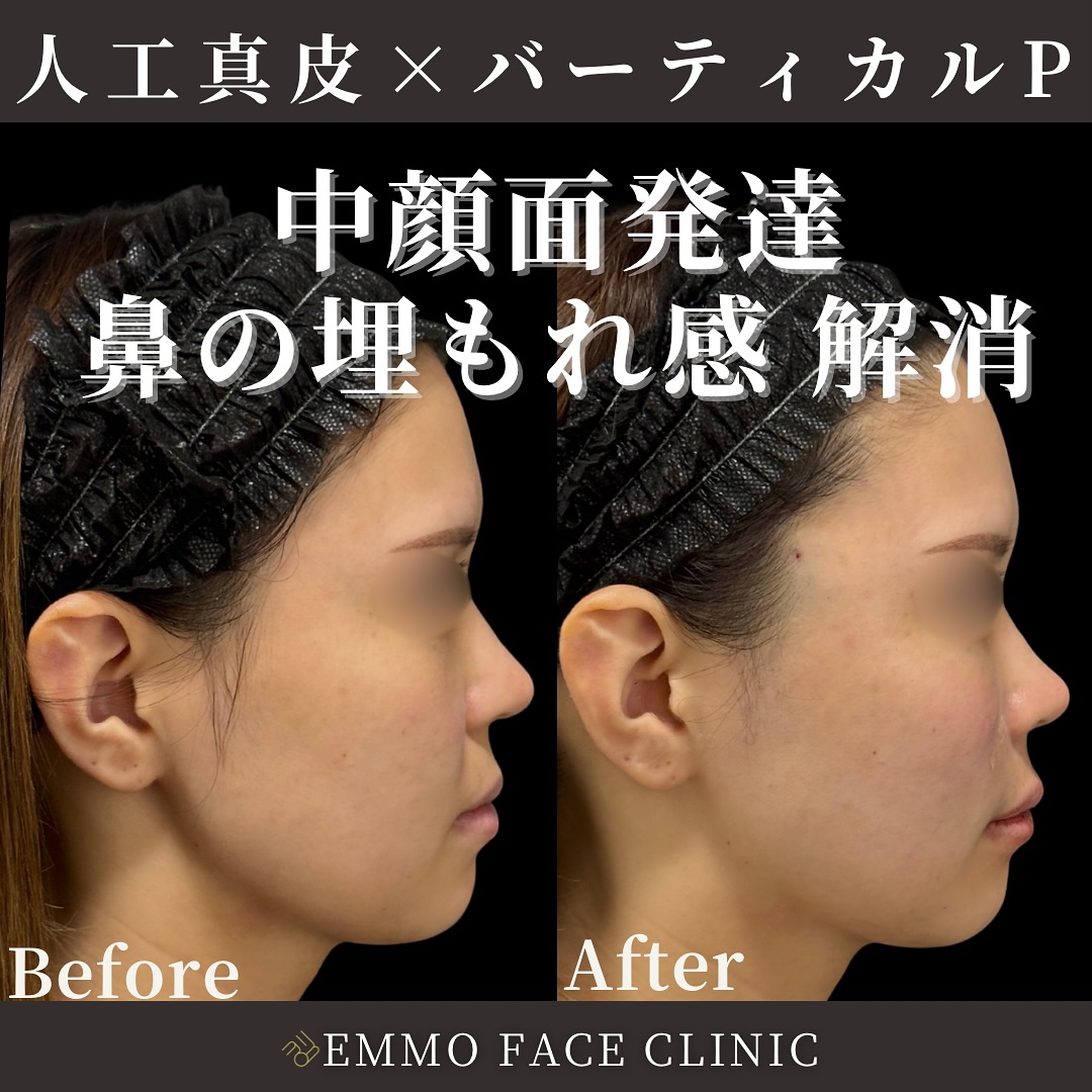 バーティカルリフトプレミアム×人工真皮