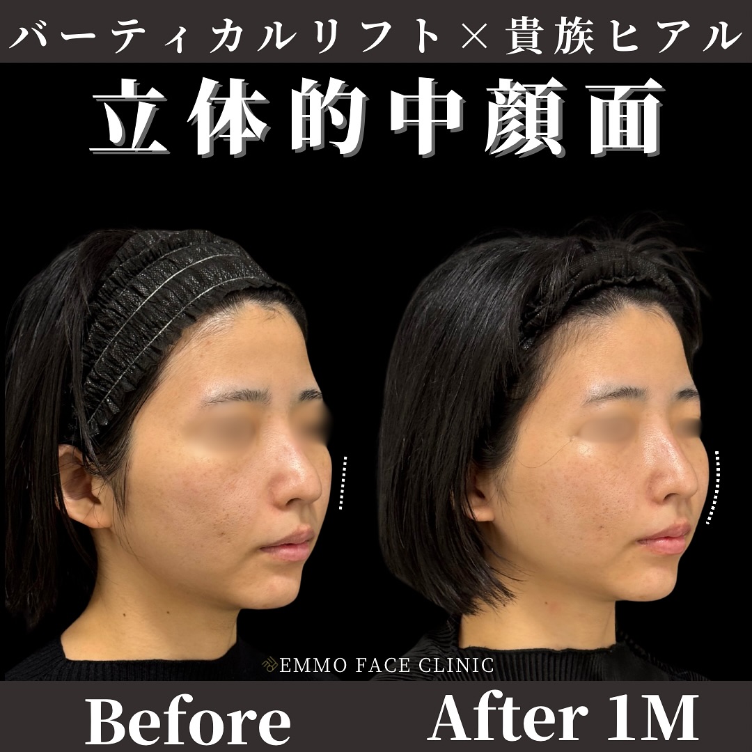 バーティカルリフト×貴族ヒアルロン酸