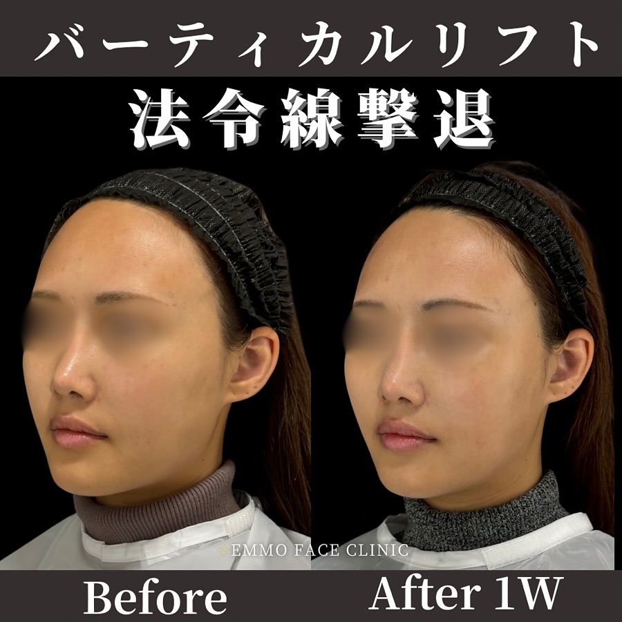 バーティカルリフト