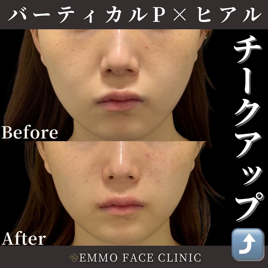 バーティカルリフトプレミアム×チークヒアルロン酸