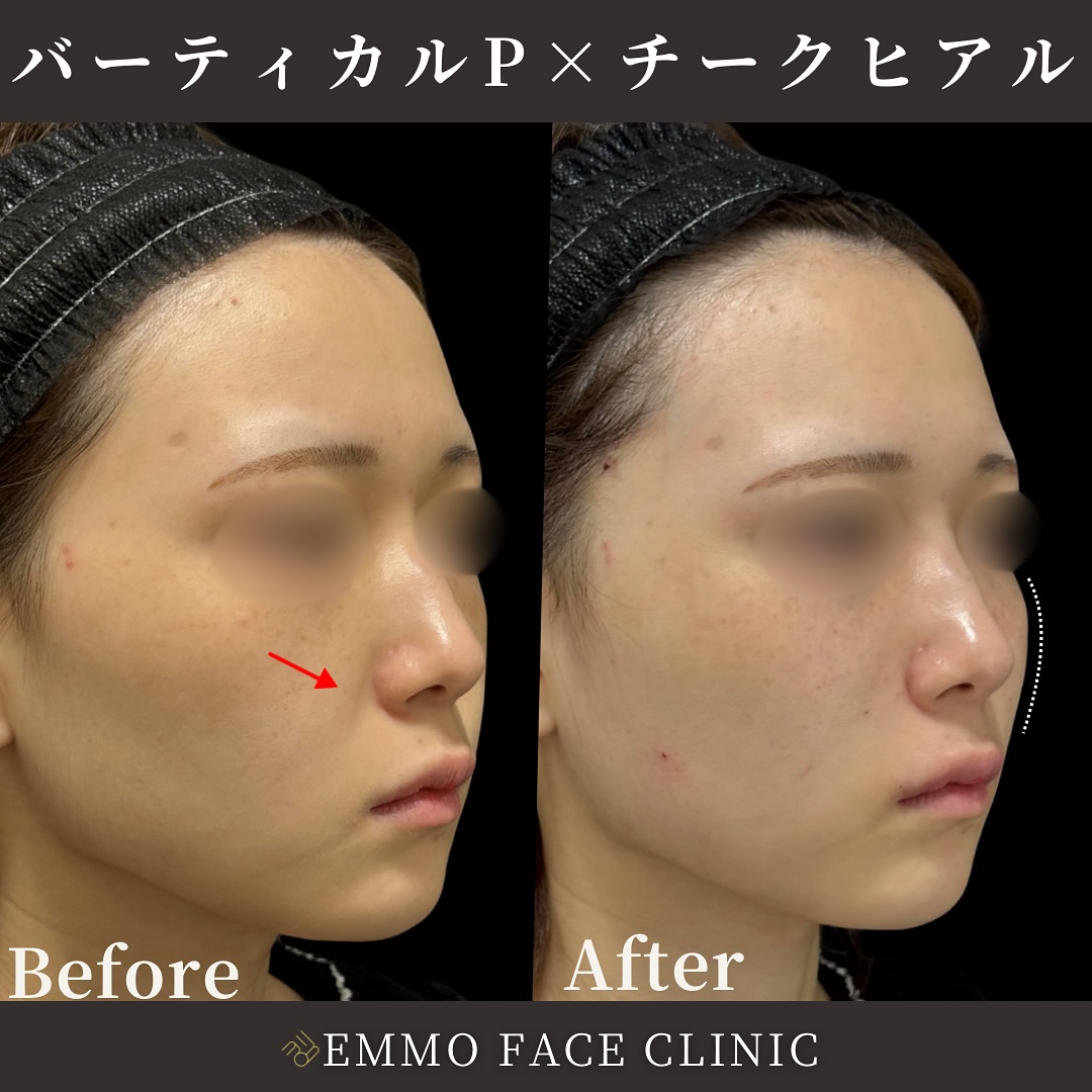 バーティカルリフトプレミアム×チークヒアルロン酸