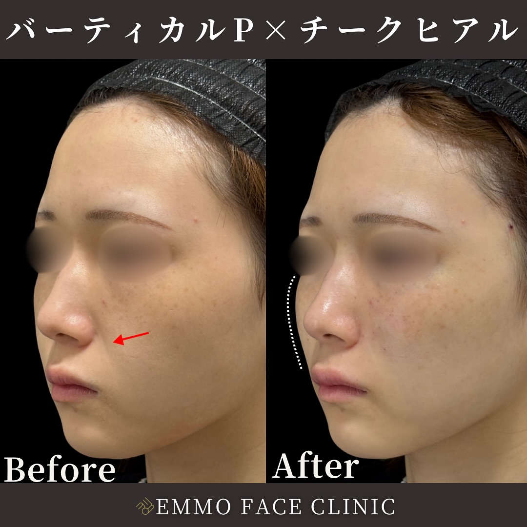 バーティカルリフトプレミアム×チークヒアルロン酸