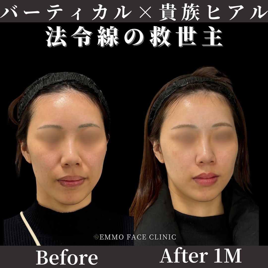 バーティカルリフト×貴族ヒアルロン酸