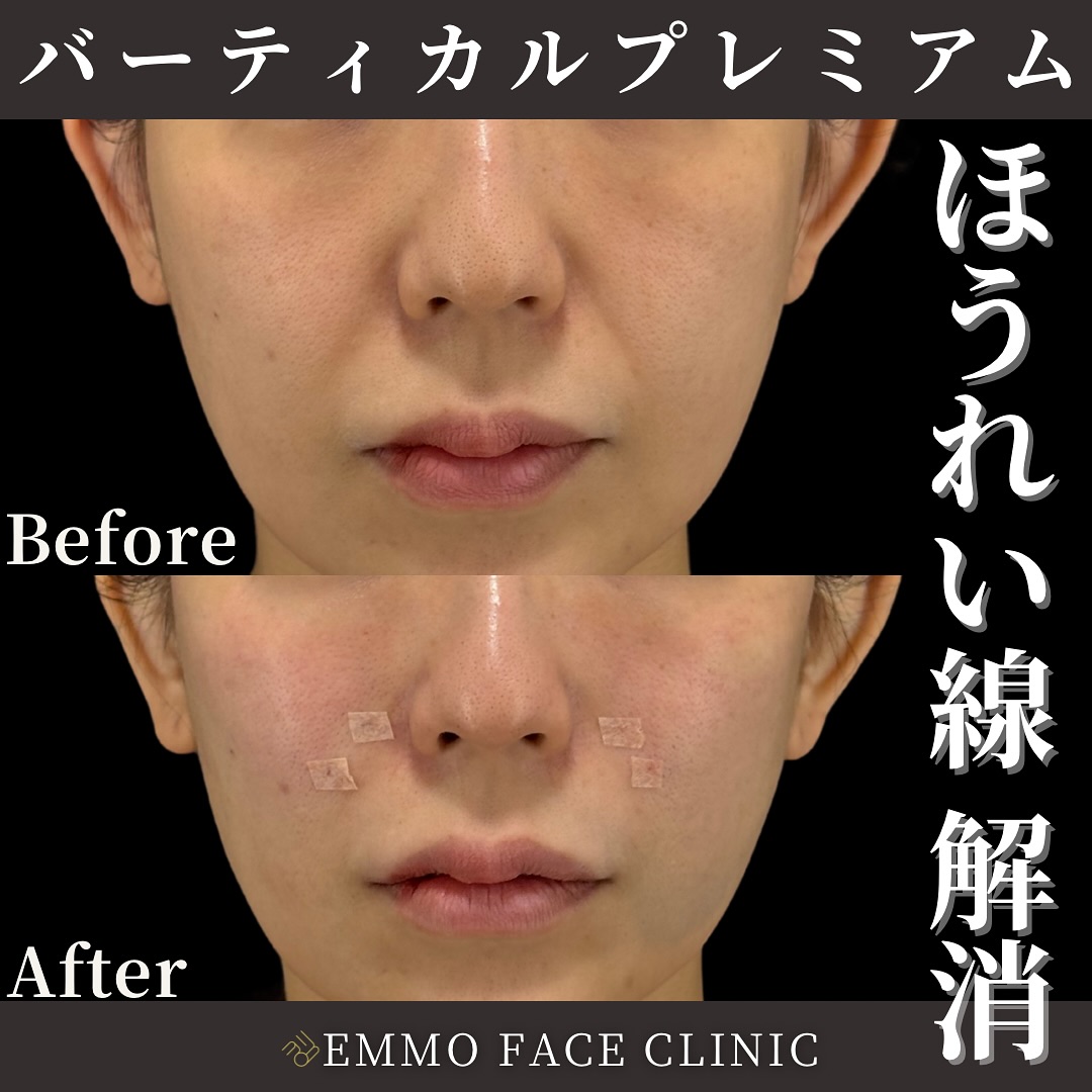 バーティカルリフトプレミアム