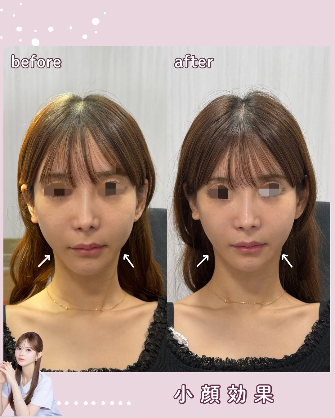 フェイスライン形成