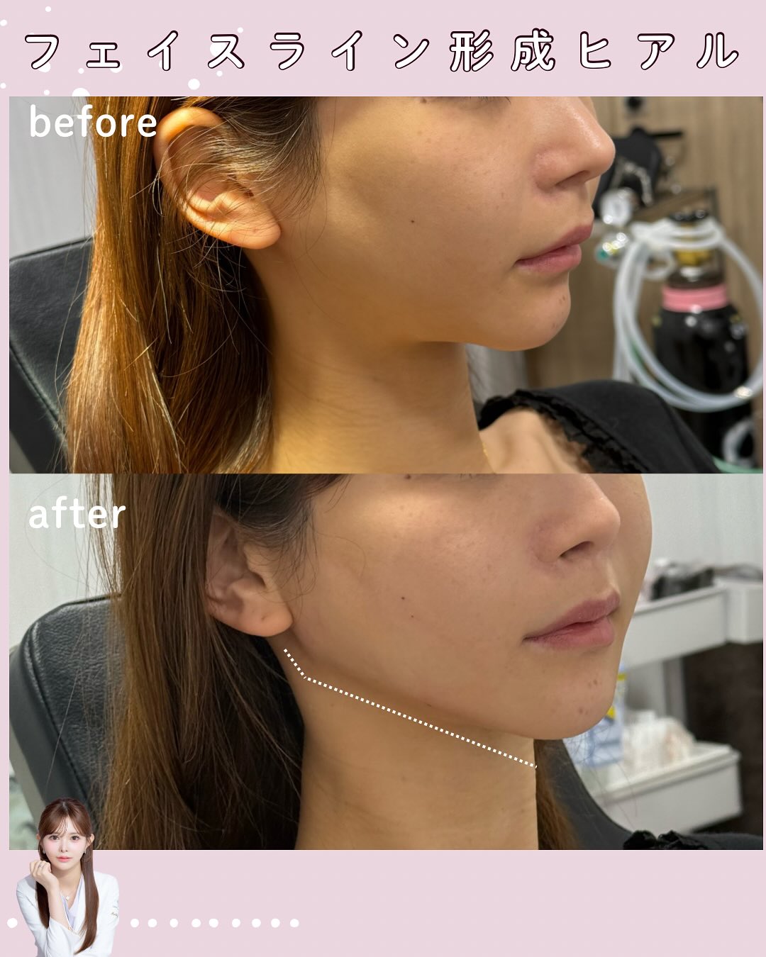 フェイスライン形成