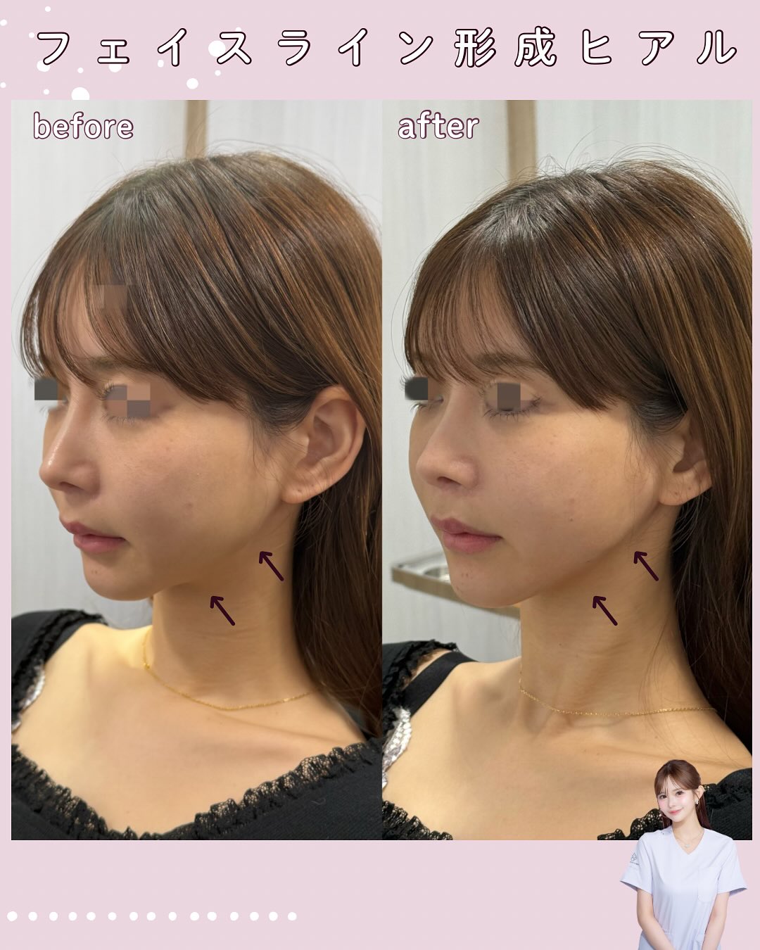 フェイスライン形成