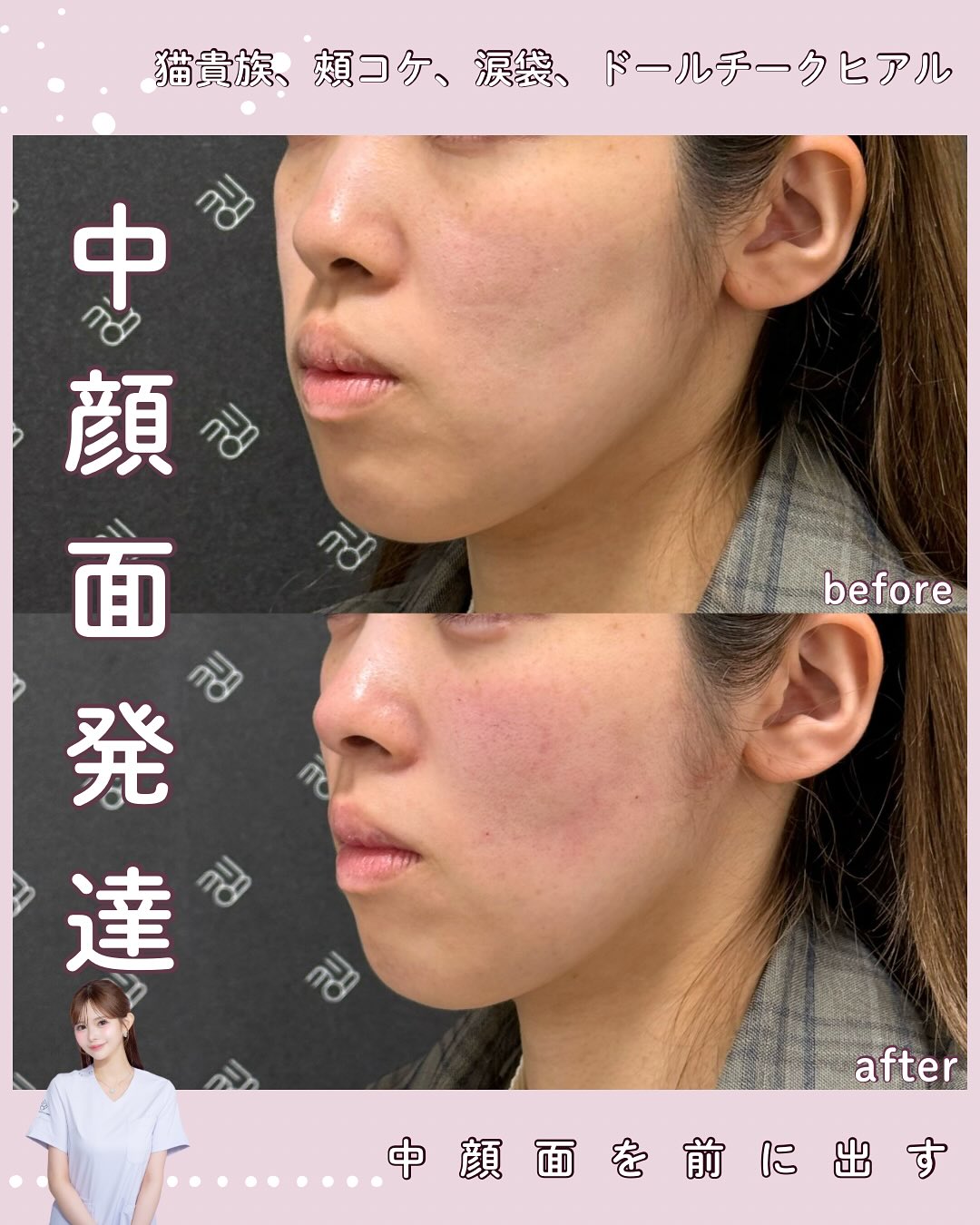 猫貴族ヒアルロン酸