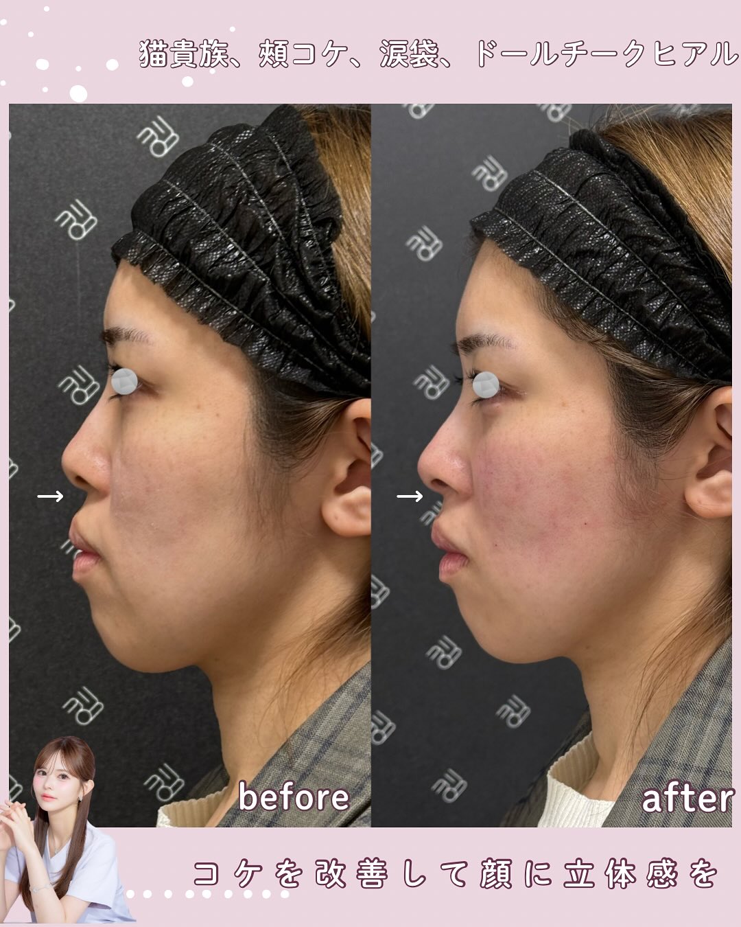 猫貴族ヒアルロン酸