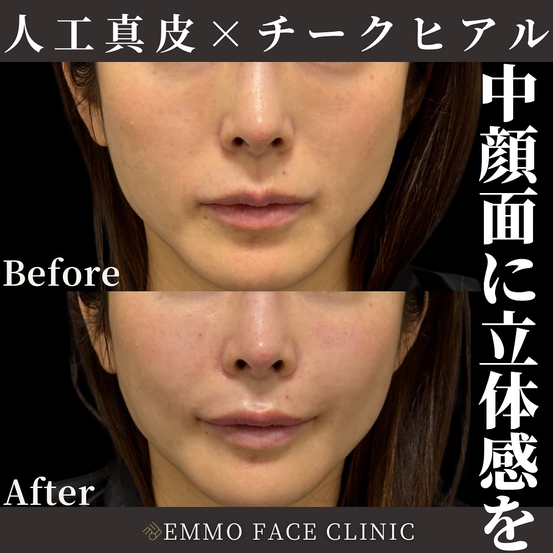 人工真皮×チークヒアルロン酸