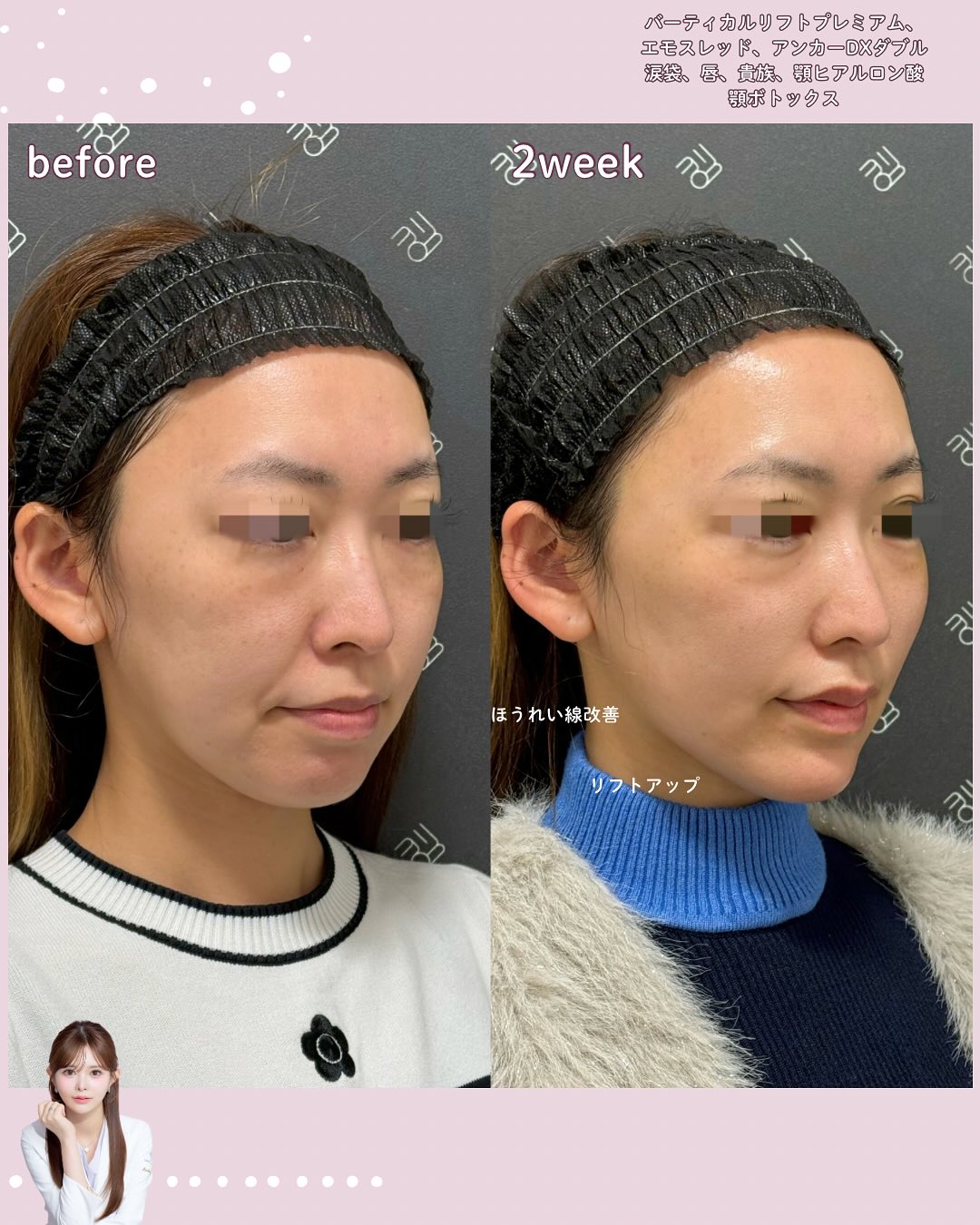 バーティカルリフトプレミアム×糸リフト×ヒアルロン酸×ボトックス