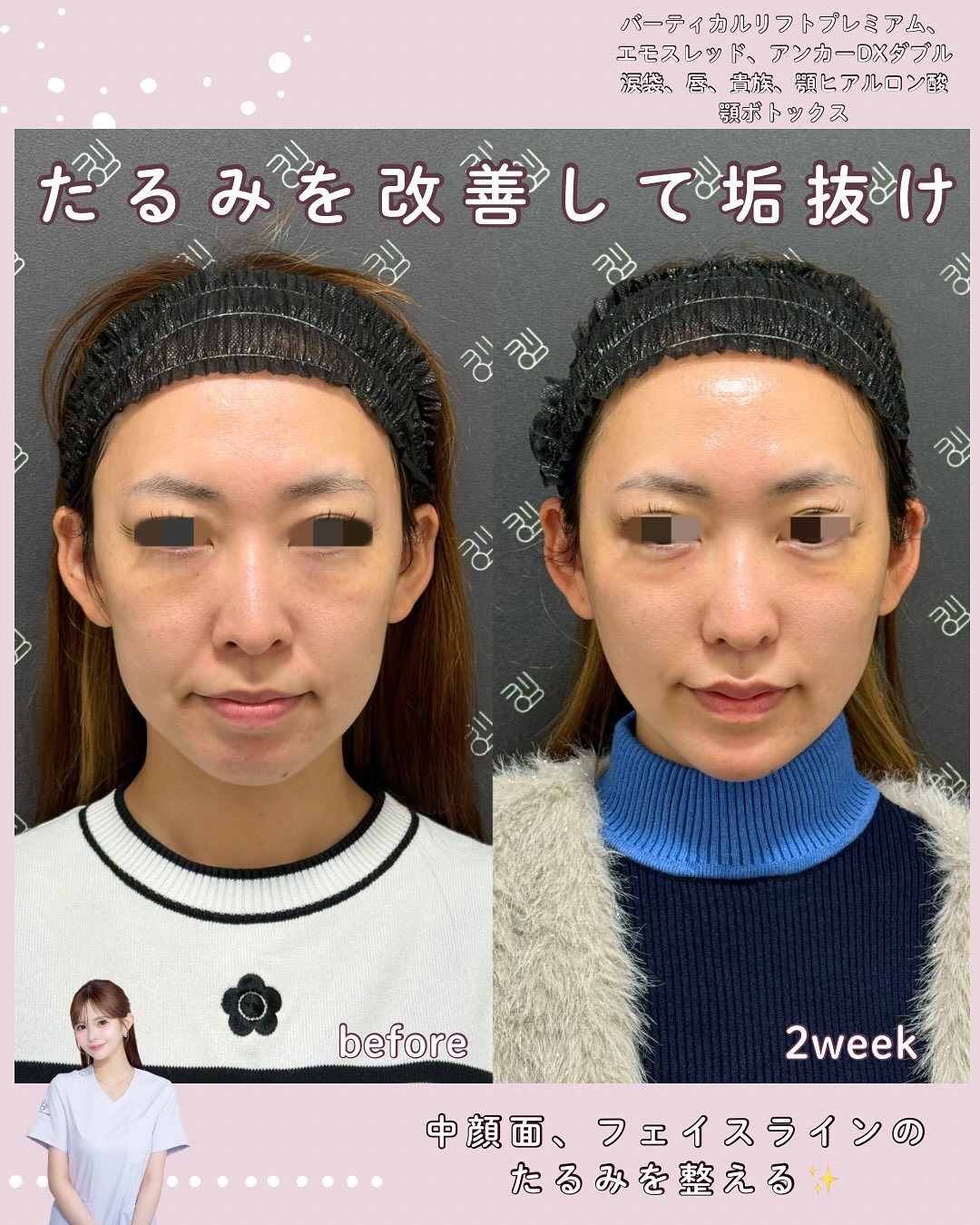 バーティカルリフトプレミアム×糸リフト×ヒアルロン酸×ボトックス